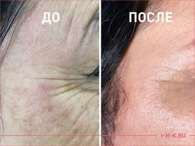 Биоревитализация гиалуроновой кислотой | Цены в Москве | Age Clinic