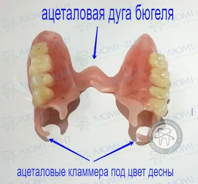 Бюгельный Протез Что Это Такое 9 Фото Виды ЛюмиДент