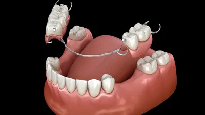 Бюгельный протез: что это, установка и съемное зубное протезирование в  клинике стоматологии, уход
