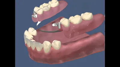 Верхний зубной протез: цена, виды протезов на верхнюю челюсть | НоваДент