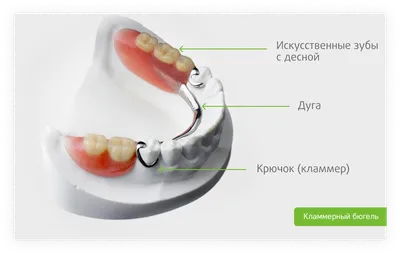 Бюгельное протезирование: Виды и Цены. На кламмерах, на аттачменах