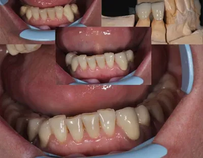 Съемное протезирование акриловыми и нейлоновыми протезами в Екатеринбурге
