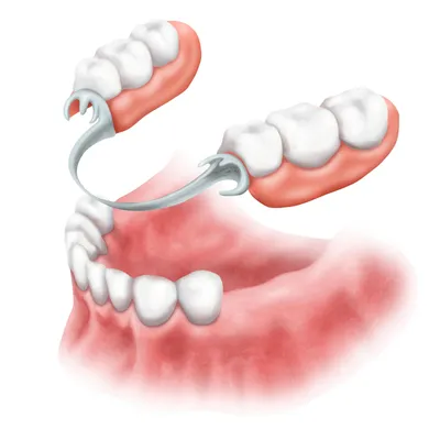 Бюгельный протез на замках в Пушкино - протез на аттачменах, цены
