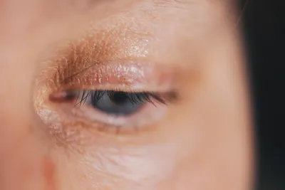 Блефарит глаз — причины, симптомы и лечение в MAJOR CLINIC