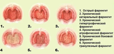 Хроинческий фарингит: симптомы и лечение | Доктор Лесков | Дзен