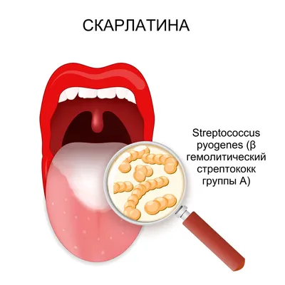 БОКОВАЯ КИСТА ШЕИ лечение в Харькове PHD.MD.KARCHINSKYI - Dr.ENT