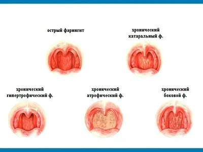 Фарингит лечение симптомы, как лечить фарингит - блог Furasol®