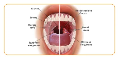 Фарингит: как проявляется и как лечить?