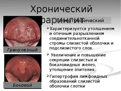 Воспаление горла, лечение, как выглядит, почему воспаляется горло — блог  Фурасол®