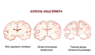 Болезнь Альцгеймера - причины появления, симптомы заболевания, диагностика  и способы лечения