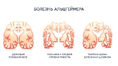 Болезнь Альцгеймера - статьи