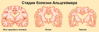 Болезнь Альцгеймера: главная причина развития — Alfabiom