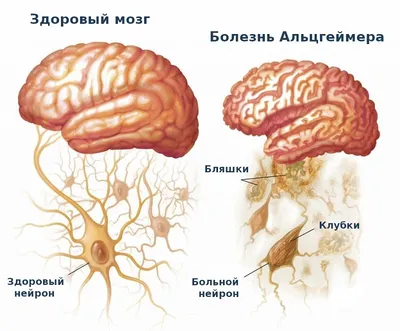 Болезнь Альцгеймера - причины, начальные симптомы и признаки, лечение  Альцгеймера || МЦ Юнона