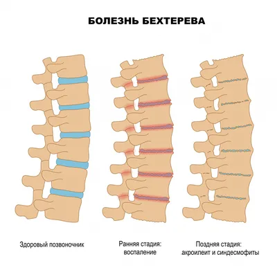 Болезнь бехтерева фото