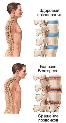 Болезнь Бехтерева: симптомы, причины, диагностика и лечение