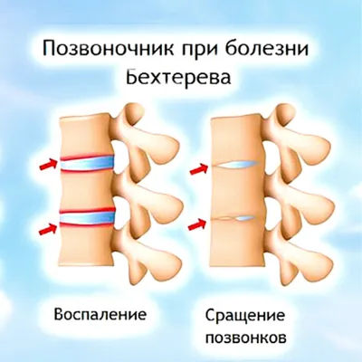 Повышение качества комплексного лечения болезни Бехтерева - научная  публикация