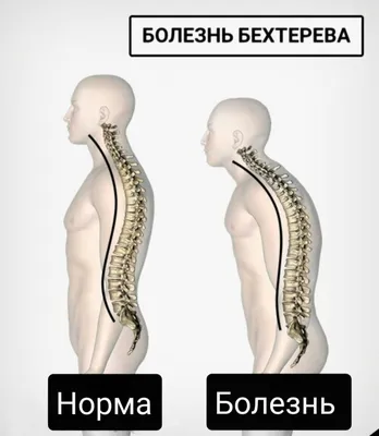 Лечение болезни Бехтерева в санатории в Татарстане