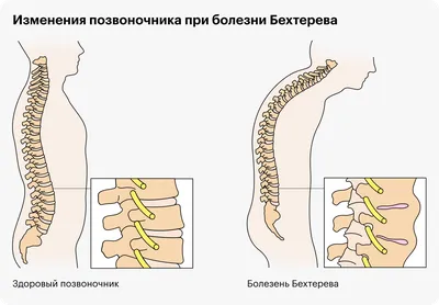 Хвороба Бехтерева - Нейрохирургия Киев