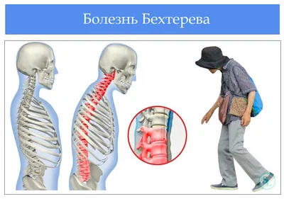 Болезнь Бехтерева: симптомы, стоимость лечения препаратами и ЛФК, причины,  диагностика