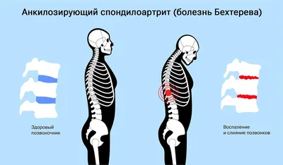 Лечение позвоночника при болезни Бехтерева или операция