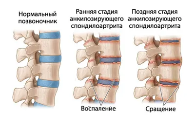 Чтобы не было мучительно больно. История борьбы с болезнью Бехтерева | Люди  | Общество | Аргументы и Факты