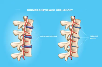 Болезнь Бехтерева: причины, симптомы, диагностика, лечение, прогноз и  профилактика