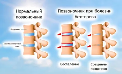 Сибирские ученые создадут тест-системы для ранней диагностики заболевания  позвоночника - Газета.Ru | Новости