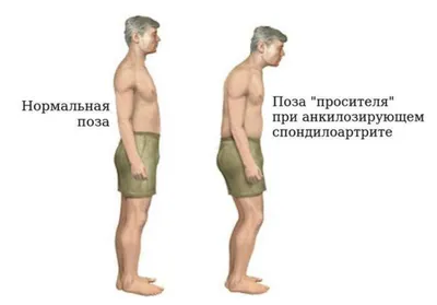 Последствия болезни Бехтерева: осложнения и лечение болезни