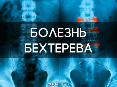 Болезнь Бехтерева: причины, симптомы, диагностика, лечение, фото