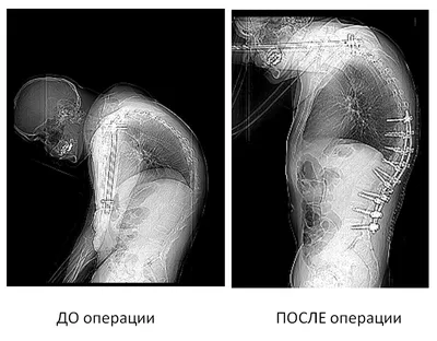 Болезнь бамбукового позвоночника или болезнь Бехтерева + клинический случай  с МРТ-картинками | Пикабу