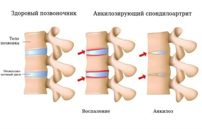 Болезнь Бехтерева-лечение и обмен опытом.Общественная организация пациентов  | Facebook