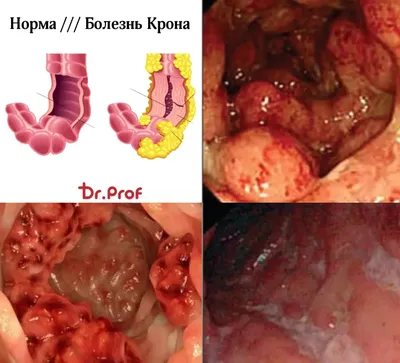 Болезнь Крона - причины появления, симптомы заболевания, диагностика и  способы лечения