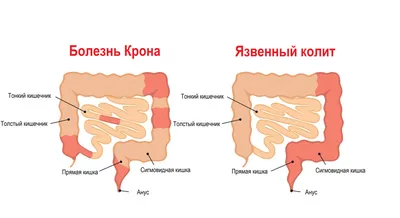 Болезнь Крона: информация для пациентов