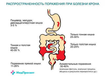 Болезнь Крона