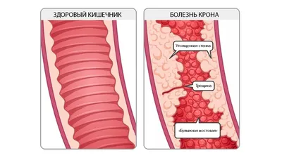 Что такое болезнь Крона и сколько стоит ее лечить