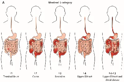 Монреальская классификация болезни Крона по локализации поражения -  эндоскопическая характеристика