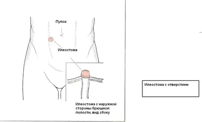 Что такое болезнь Крона и сколько стоит ее лечить