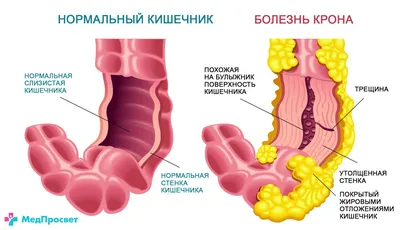 Болезнь Крона: причины, симптомы и лечение в статье эндоскописта Магомедов  С. М.