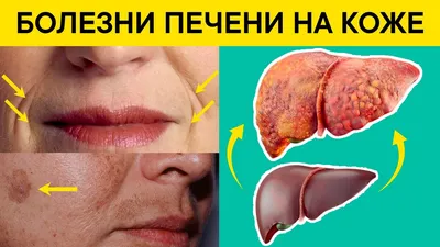 Как определить по коже, что у вас серьезная болезнь печени - Срочные  новости Узбекистана: Repost.uz