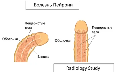 ➡️ Болезнь Пейрони. Симптомы и причины болезни Пейрони. Лечение болезни  Пейрони , лечение в Москве - Девита (Devita)