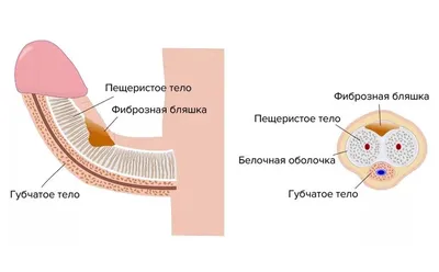 ММЦ Медикал Он Груп-Оренбург - 📍Болезнь Пейрони📍 – это искривление  полового члена, которое развивается из-за уплотнения пениса и разрастания  фиброзной ткани, что делает эрекцию болезненной. ⠀ 💥 Диагностируют это  состояние у 0,3-1%