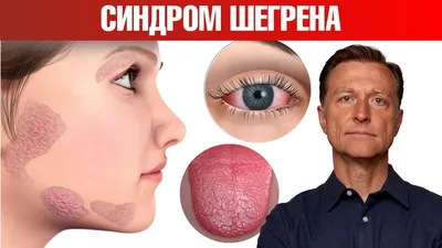 Самый эффективный протокол при синдроме Шегрена✓ - YouTube