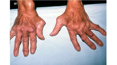 Последствия ревматоидного артрита: осложнения и лечение