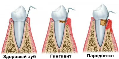 Болезни десен: методы нехирургического лечения в Минске