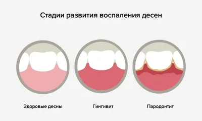 Воспалилась Десна 9 Советов Что Делать Киев ЛюмиДент