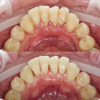 Лечение кровоточивости десен в Калининграде, воспаление десен - Ортодонт в  Калининграде в стоматологии Ортодонт-ЛЮКС