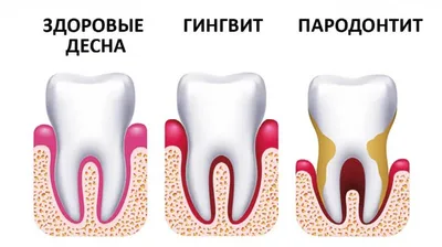 Воспаление Десен У Детей Гингивит У Ребенка Киев ЛюмиДент