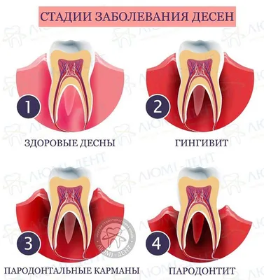 Болезни Десен Какие Бывают Клиника ЛюмиДент