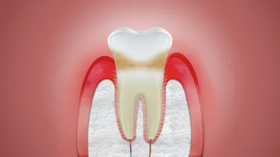 Заболевания десен: гингивит и пародонтоз