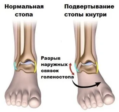 Артроз голеностопного сустава: причины, симптомы, лечение суставов.